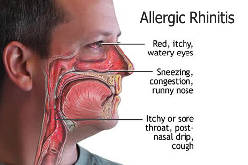 Allergic-Rhinitis