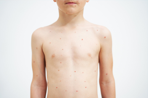Chickenpox