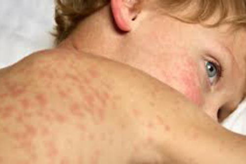 Measles