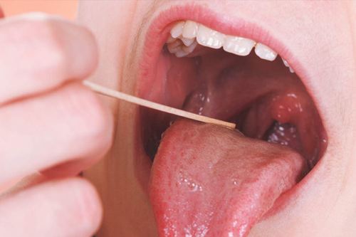 Recurrent-Tonsillitis