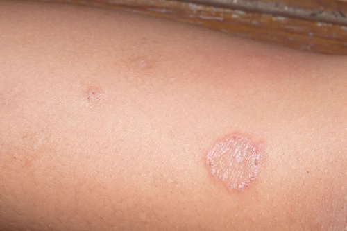 Ringworm