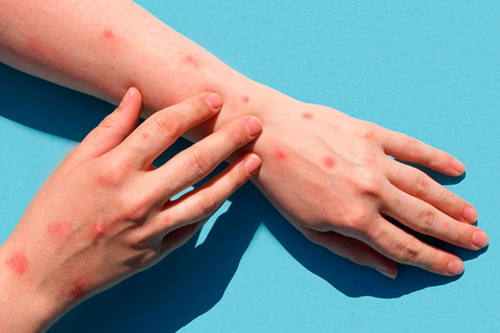 Smallpox