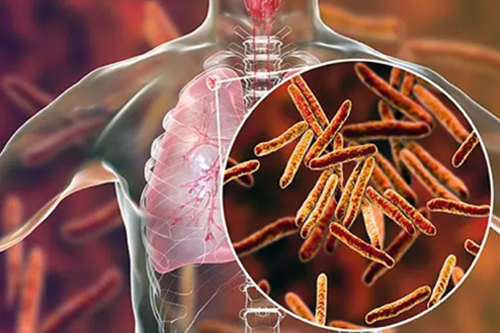 Tuberculosis