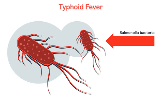 Typhoid