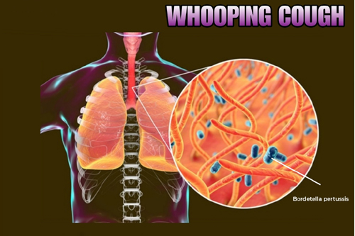 Whooping-caugh