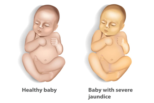 neonatal-jaundice